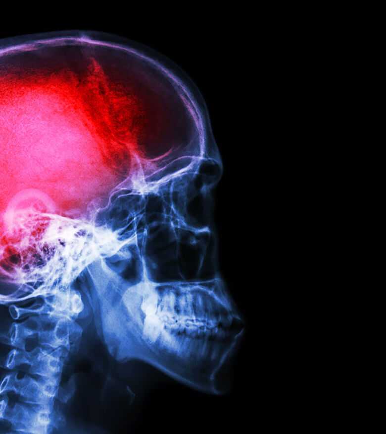 Brain Injury Lawyers in Miami, FL - Brain scan