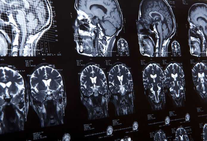 Brain Injury Attorneys in Columbus, GA - Brain injury Scan