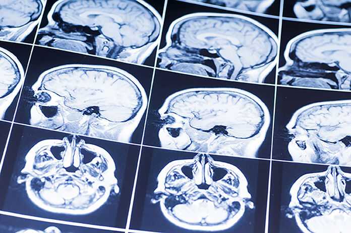 Brain Injury Lawyers in Lexington, KY - Brain scan