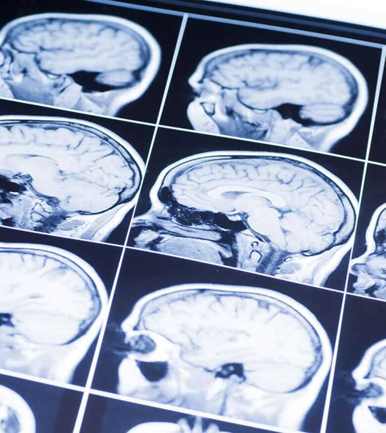 Melbourne Brain Injury Lawyers - Brain injury scan