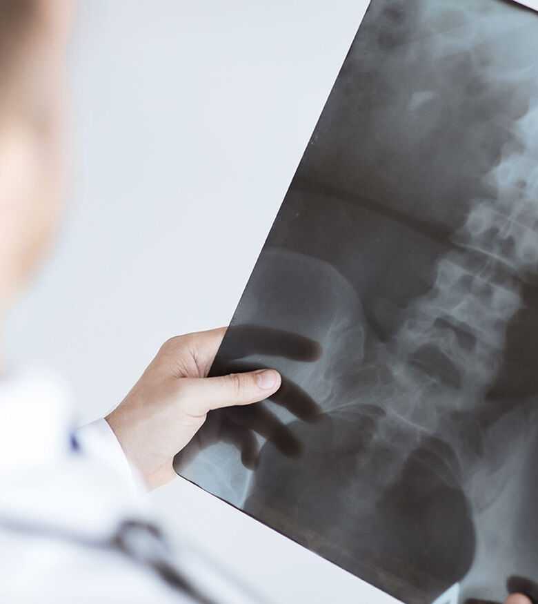 Atlanta Spinal Injury Lawyers - Doctor looking at spine xray