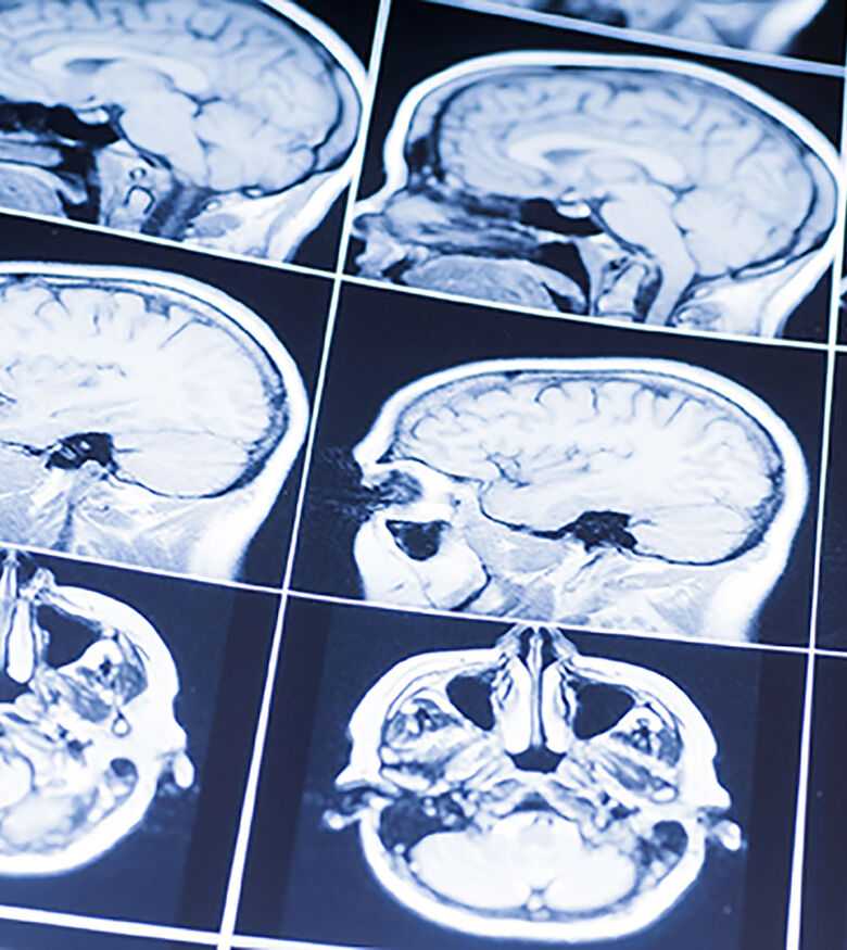 Brain Injury Lawyers in Lexington, KY - Brain scan