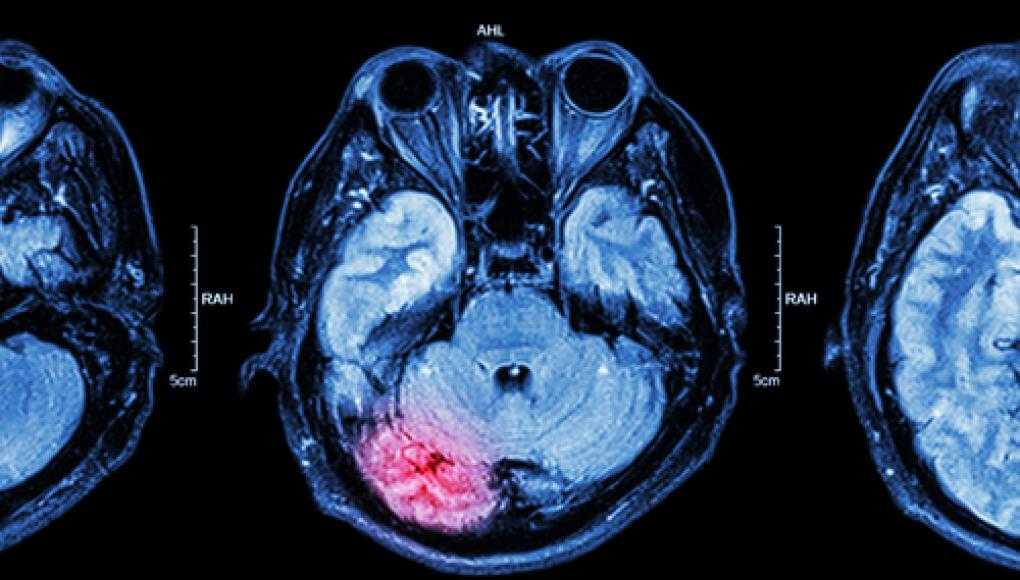 Concussions, Brain Injuries on the Rise in Youth - brain injury scan