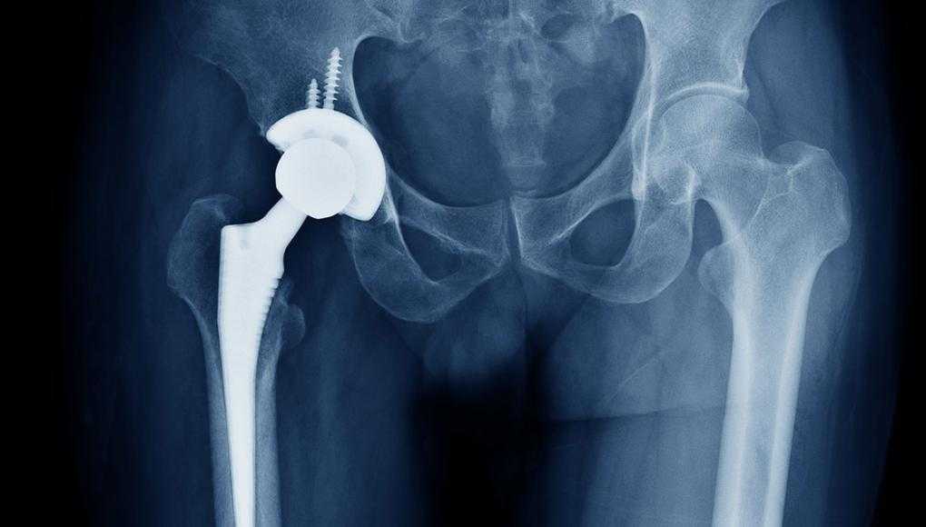 hip replacement lawsuit