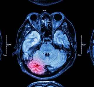 Concussions, Brain Injuries on the Rise in Youth - brain injury scan