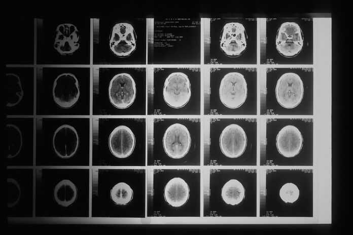 New York Brain Injury Attorneys - brain scans with injuries