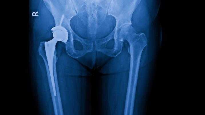 X-ray of a hip replacement