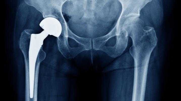 Hip replacement x-ray