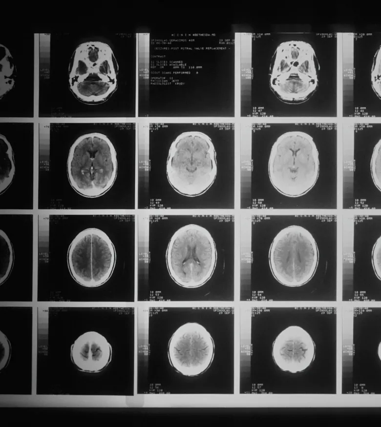 Fort Lauderdale Brain Injury Attorneys - brain scan with injuries