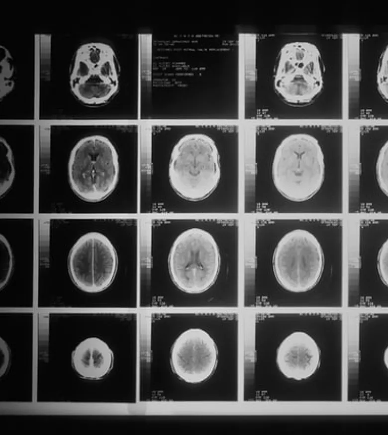 Tallahassee Brain Injury Attorneys - brain scans