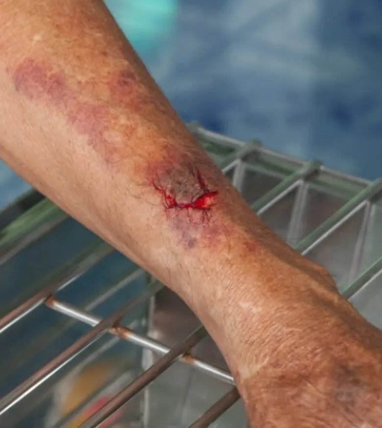 Palm Harbor, FL Burn Injury Lawyers - Arm with Burn Injury 