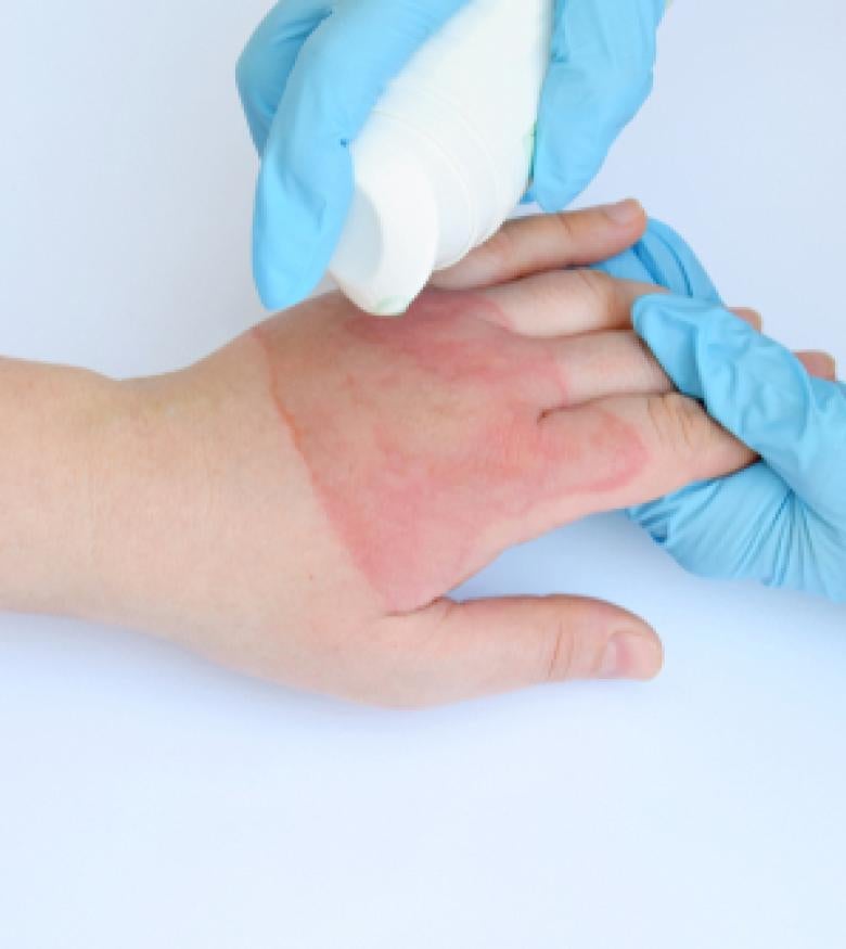 Doctor treating a hand burn, contact a burn injury attorney in New Albany for assistance.