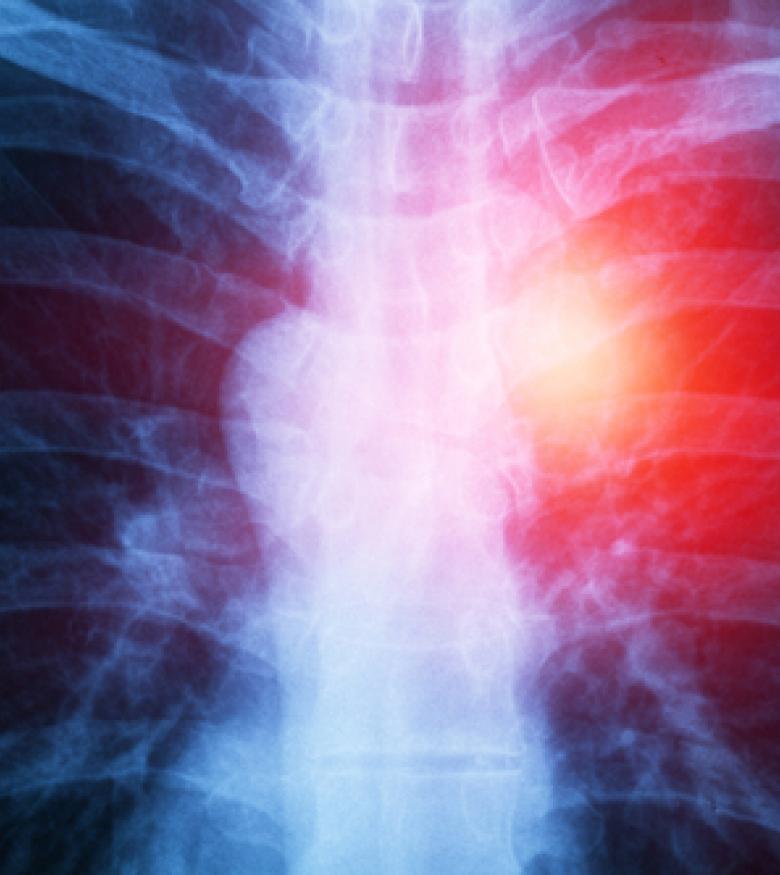 An X-ray image of a chest with a highlighted area, suggesting mesothelioma, emphasizing the need for a Mesothelioma Lawyer in The Bronx for legal assistance.