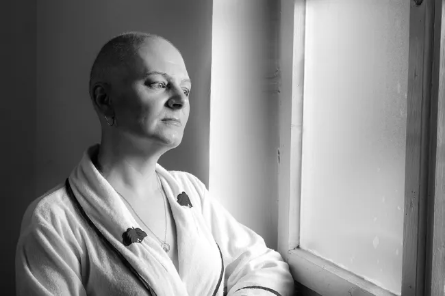 After Chemo: What It's Like for Breast Cancer Patients to Live with Permanent Hair Loss - hair loss